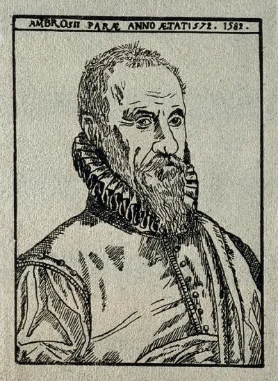 Ambroise Paré. Reproduction of woodcut after E. Delaune, 1582
