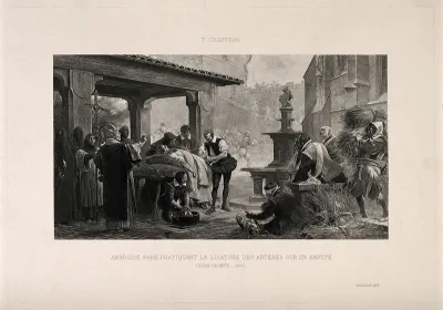 Ambroise Paré using a ligature on an artery of an amputated leg of a soldier, during the Siege of Metz, 1553