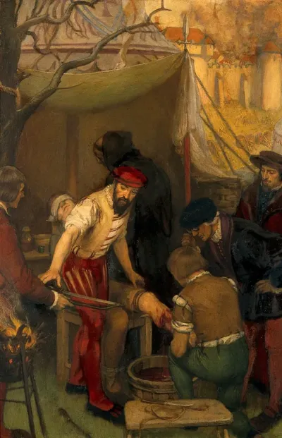 Ambroise Paré using the ligature when amputating at the siege of Damvillers, 1552