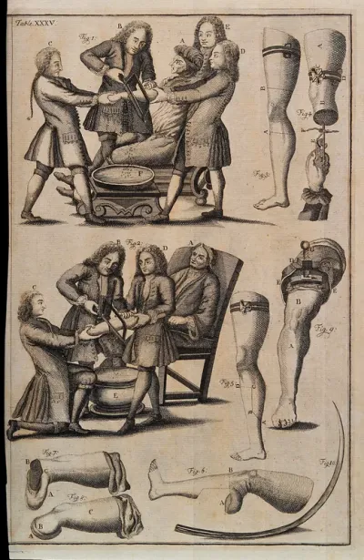 Amputations of arm and leg with diagrams to illustrate how to perform the operations