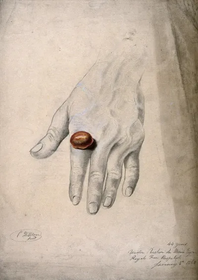 An abcess on the finger of a man