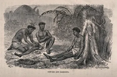 An African medicine man cupping and bleeding two patients