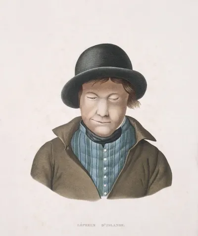 An Icelandic man with leprosy