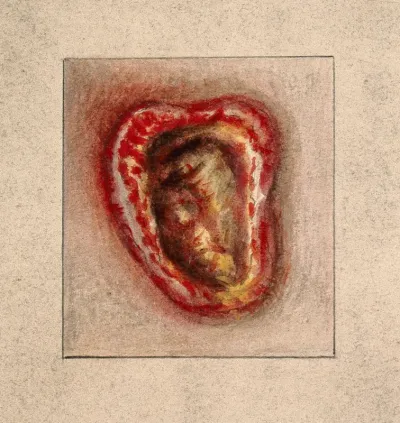 An infected sore [?] on a woman's body