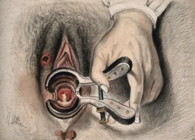 An infected sore on the female genitalia shown with the aid of a vaginal speculum