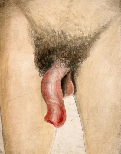 An inflamed and deformed penis
