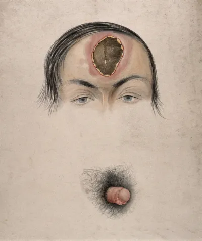 An open wound on the forehead of a man, with a detail below showing a diseased penis (?) Watercolour by C