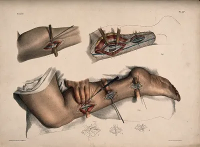 An operation being performed on a leg and ankle