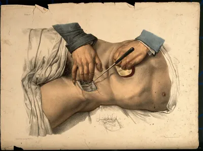 An operation being performed on the lower abdomen of a male patient