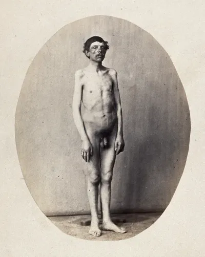 An unclothed standing man, viewed in full length from the front