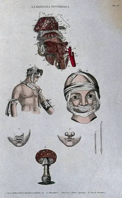 Anatomy, surgery and botany; top, dissected head showing arteries; centre, methods of bandaging the thorax and head; below, cleft lip (harelip) and instruments for surgery on it; bottom, fly agaric mushroom