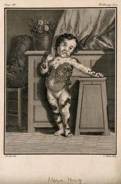 Anna Maria Herig, a girl with a skin disease: anterior view