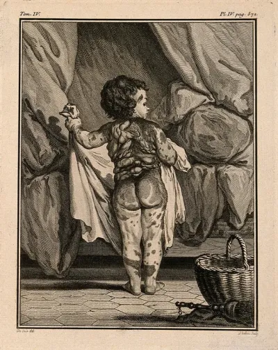 Anna Maria Herig, a girl with a skin disease: posterior view