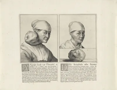 Anneke Jacobs from Thetenbul Before and After Surgery