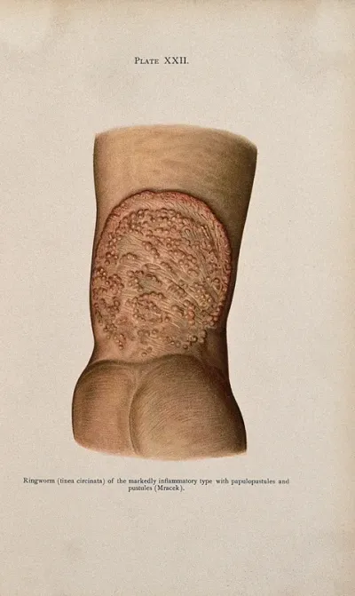 Area of diseased tissue on the wrist of a patient suffering from ringworm (tinea circinata), including papulopustules and pustules