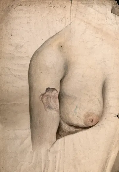 Area of scar tissue on the upper arm of a woman, with the right breast also shown