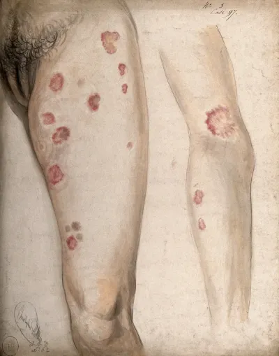 Areas of diseased skin on the arm and leg of a woman