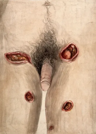 Areas of severely diseased tissue on the thighs and groin of a man showing symptoms of perforating phagedena