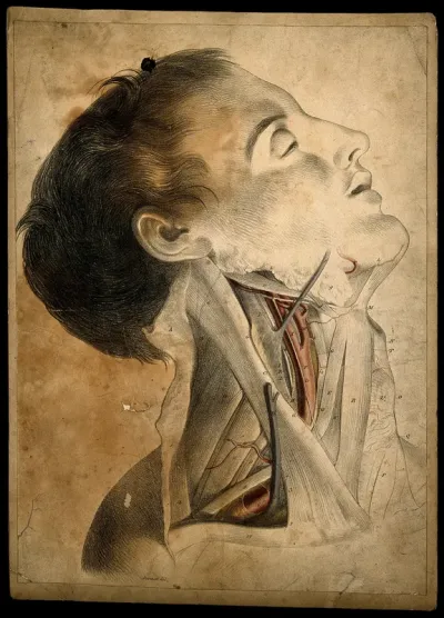 Arteries of the neck: dissection
