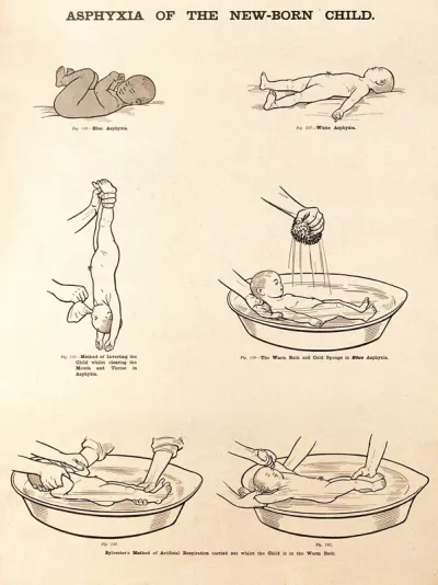 Asphyxia of the new-born child and its treatment