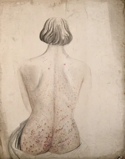 Back and buttocks of a woman suffering from a rash of sores