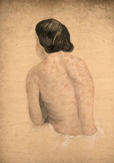 Back of a woman suffering from skin covered in a rash caused by syphilis