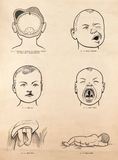 Birth-defects in the new-born child