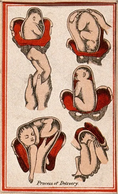 Birth of a baby: five figures, showing the process of delivery