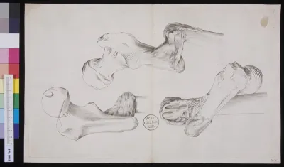 Bones from the leg: fractures