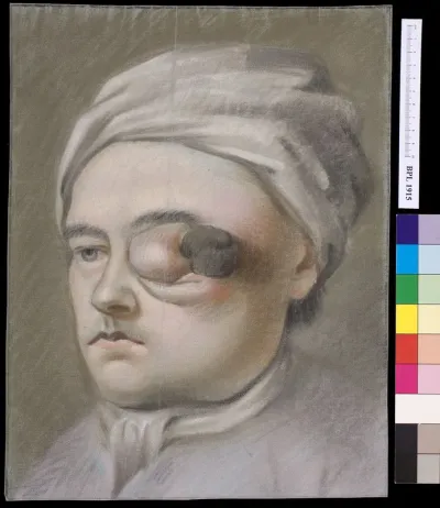 Boy's head with tumor of the eye