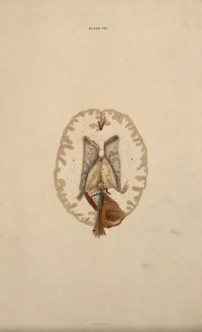 Brain: dissection showing the lateral ventricles and mid-brain