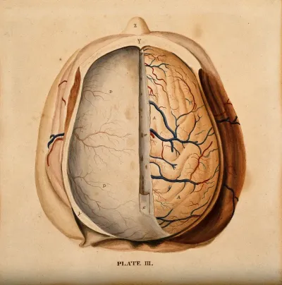 Brain: dissection showing the top of the brain, with the dura mater of the left hemisphere and the gyri of the right