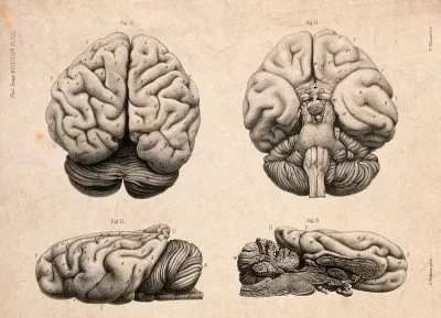 Brain of a "European female idiot" aged 42 years: four figures