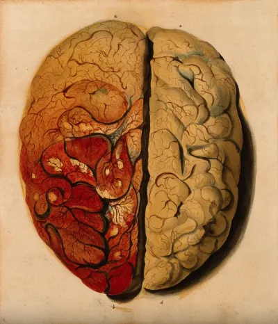 Brain: view from above, showing the gyri, with one hemisphere covered with pia mater