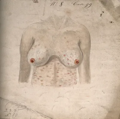 Breasts and chest of a woman suffering from a rash of sores