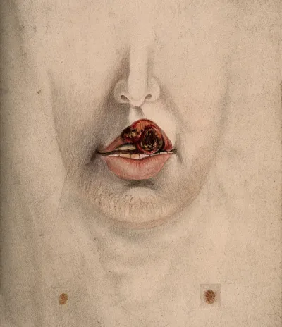 Chancre of the lip on the mouth of a man, with details showing sores
