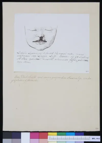 Child with cleft palate