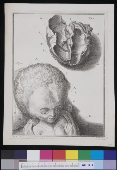 Child with hydrocephalus