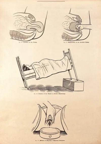 Childbirth. Lithograph after W. F. Victor Bonney
