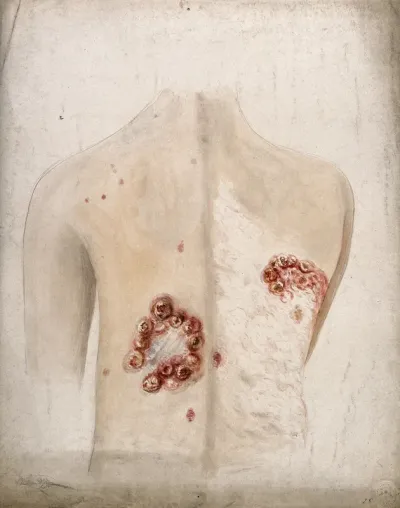 Clusters of abcesses or sores on the back of a woman