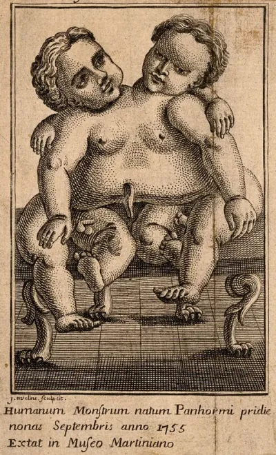 Conjoint twins born at Palermo in 1755
