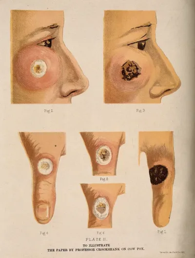 Cowpox: areas of affected skin on the face and thumb of a patient, showing the development of the disease (possibly after vaccination?)