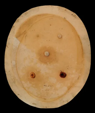 Cowpox pustules from the sixth to the eighteenth days of the disease