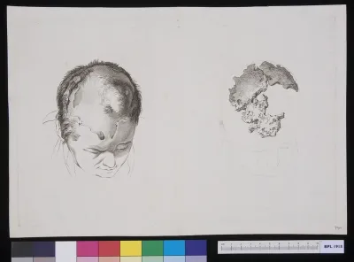 Crumbling bone in the skull