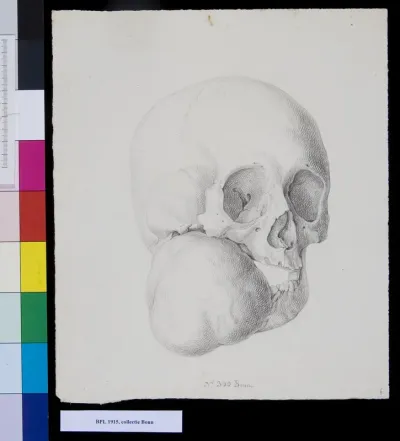 Deformation of the lower jaw
