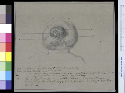 Deformed child, seen from behind