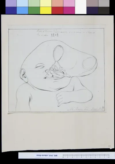 Deformed head of a child