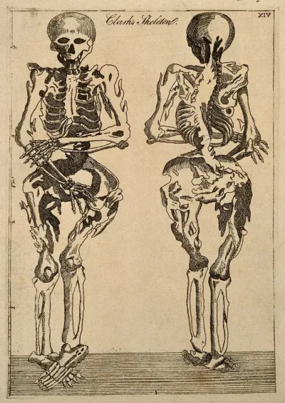 Deformed human skeleton, front and back views