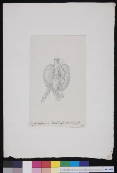 Deformed kidneys