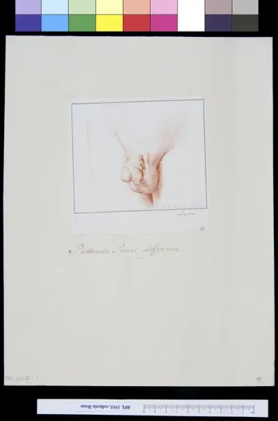 Deformed male genitals